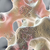 Osteoporose: Nicht nur Frauen sind betroffen